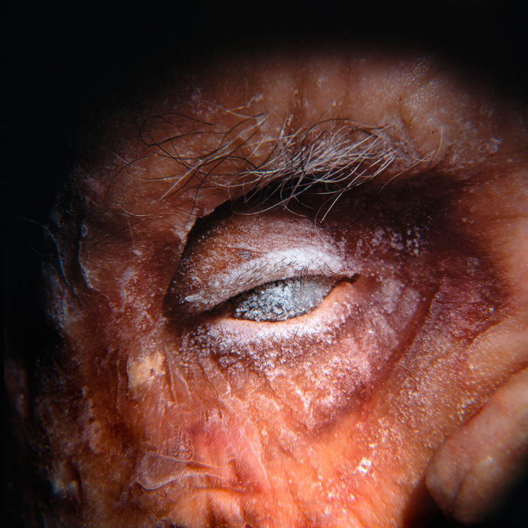 Portrait of a frozen dead human body with frozen eye